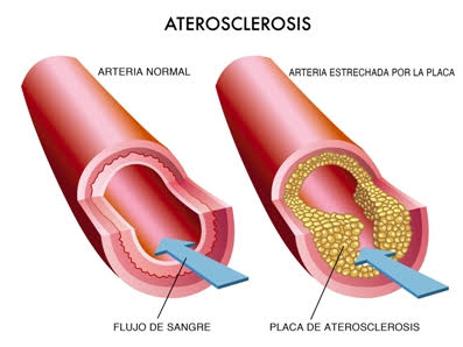 Sintomas y Tratamientos para la aterosclerosis en mexico, guadalajara, cancun, los cabos y monterrey | IGEA MEXICO