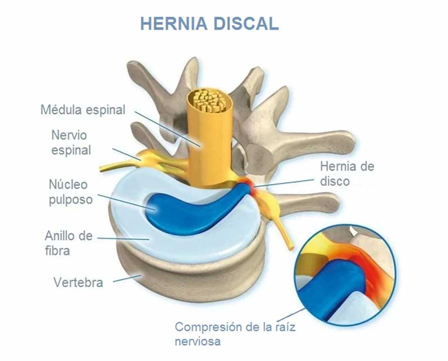 Cómo Tratar la Parálisis por Compresión de Disco en la Columna | Servicios y equipos medicos de columna en méxico | IGEA