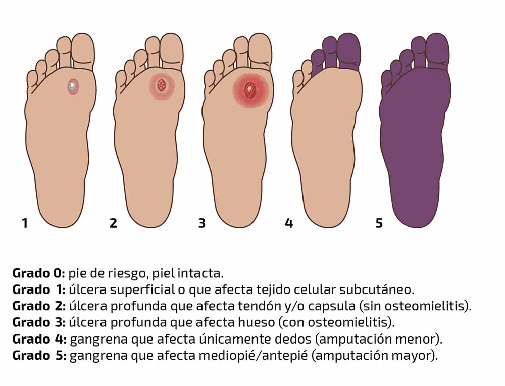 ¿Cuáles son las Etapas del Pie Diabético? | Servicios y Equipos Medicos en Guadalajra | IGEA México