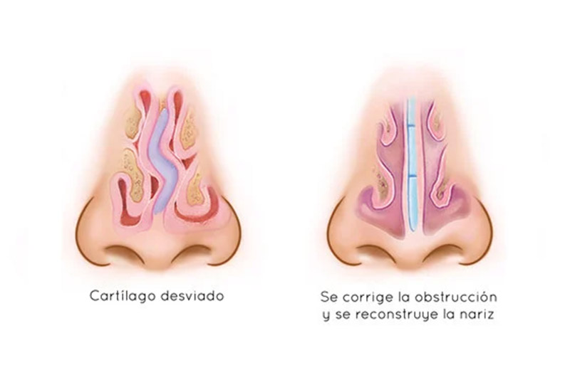 Cirugia de nariz en México | septoplastia | IGEA