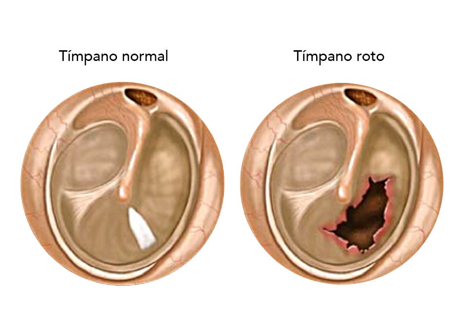 Timpanoplastía | Especialistas en Cirugías de oído en Mexico | IGEA