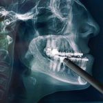 Motor Quirúrgico para cirugia maxilofacial en Mexico | renta y venta de equipos en guadalajara
