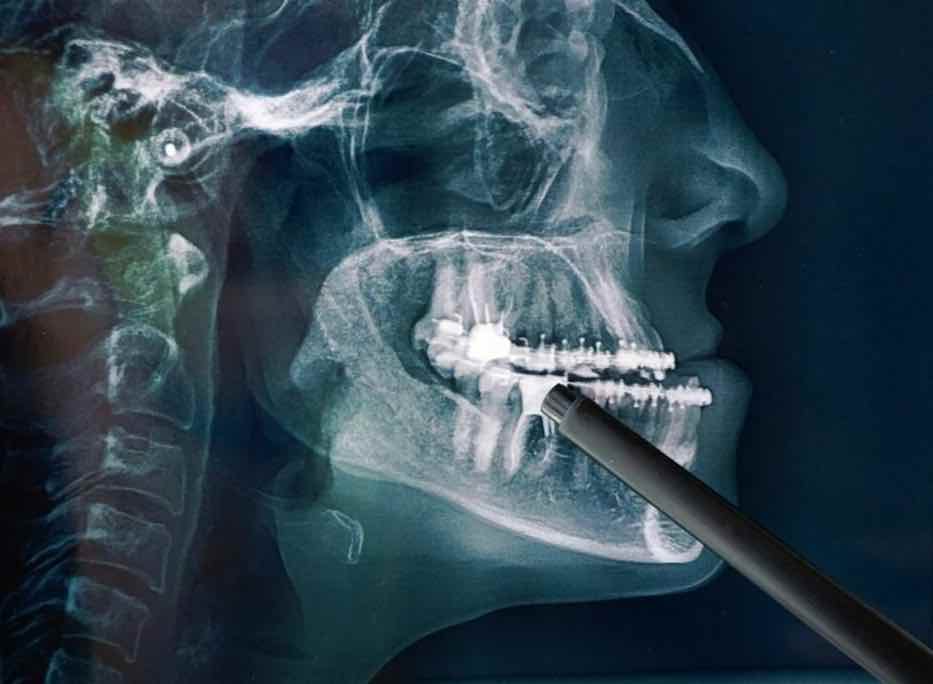 Motor Quirúrgico para cirugia maxilofacial en Mexico | renta y venta de equipos en guadalajara