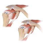 Spider Smith & Nephew mexico | artroscopia de hombro | soluciones quirurgicas para trauma en guadalajara