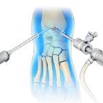 equipo de radiofecuencia VAPR3 mexico | . Medicina Deportiva y Lesiones por Sobreuso en guadalajara