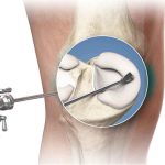 posicionador spider tenet Smith & Nephew mexico | Cirugia de Rodilla en Guadalajara