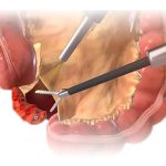 ¿Cómo Funciona el Equipo AEX de Medtronic? | renta y venta de equipos en guadalajara