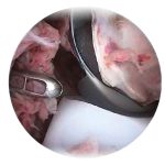 ¿Cómo Funciona el Rasurador para Artroscopia? | medicos especialistas en guadalajara