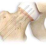 Drill TPS de Stryker Mexico | Soluciones para Trauma Y Neuro en Guadalajara | IGEA Mexico