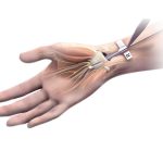 Mini Sierra de Mano TPS de Stryker en Mexico | IGEA Soluciones Medico Quirurgicas en Guadalajara