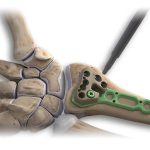 Pieza de Mano TPS Universal Driver | Stryker Mexico | Especialistas en Cirugias de Trauma en Guadalajara | IGEA