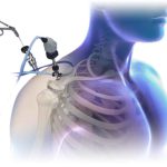 Piezoeléctrico Ultrasurgery Mexico | Medicos Especialistas en Trauma en Guadalajara