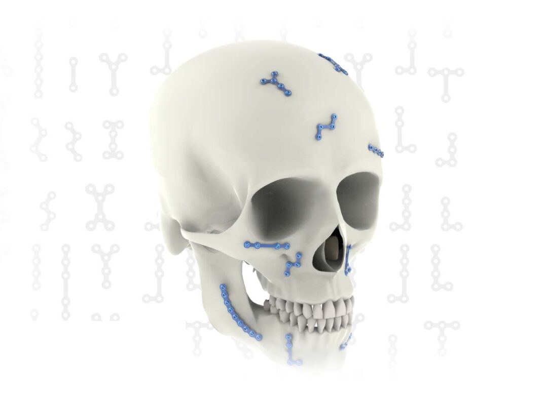 Set Maxilofacial Synthes mexico | Soluciones medico quirurgicas para Cirugías Faciales y Reconstructivas en Guadalajara | IGEA