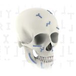 Set Maxilofacial Synthes mexico | Soluciones medico quirurgicas para Cirugías Faciales y Reconstructivas en Guadalajara | IGEA