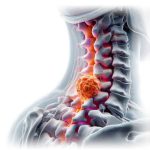 Tipos de Cirugías del Drill TPS en Mexico | IGEA Soluciones Medico Quirurgicas en Guadalajara