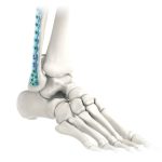 Ventajas Reales del Drill de Stryker para Cirujanos | IGEA Mexico