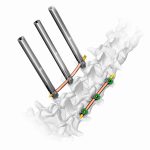 tps u drill en Neurocirugía y Cirugía de Columna en Mexico | Venta y renta de equipo en guadalajara