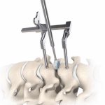 Procedimientos Clave del e Retractores Cervicales | especialistas en cirugia endoscopica de columna en Mexico