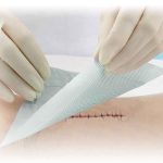 Protector de Piel Sureprep Mexico | soluciones para heridas