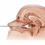 Set Endoscópico Endonasal Kelly Mexico | soluciones endoscopicas para cirugias d ebase de craneo | IGEA MEXICO