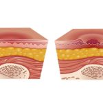 Tipos de Lesiones Ideales para Cavilon 3M Mexico | IGEA