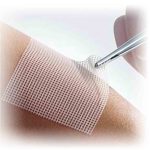 ¿Qué Tipo de Heridas Necesitan Jelonet? | gasa parafinada Jelonet en mexico | IGEA soluciones medico quirurgicas