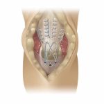 Ancla con Sutura Corkscrew Mexico | soluciones medico quirurgicas para trauma y orotpedia en mexico | IGEA