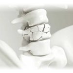 Cemento Óseo Radio-Opaco SpinePlex | soluciones para cifoplastia y vertebroplastia en mexico | IGEA