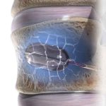 Cifoplastia Convencional con Stent de Titanio | Productos y Servicios Medicos en Guadalajara