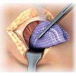 Malla Abdominal Expandible Mexico | parche expandible para hernias | IGEA
