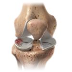 reparación de meniscos all-inside mexico | soluciones quirurgica para trauma y ortopedia | IGEA