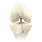tornillo de interferencia RCI mexico | soluciones para trauma y orotpedia | IGEA