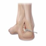 Cable para pasar suturas | Soluciones para Traumatología y Ortopedia en México | IGEA