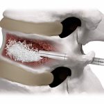 Cemento Óseo Depuy | Soluciones para Traumatología y Ortopedia en México | IGEA