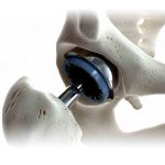 Cemento quirurgico Depuy Mexico | Soluciones para Cirugias de Cadera | IGEA