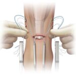 FiberWire Arthrex | Soluciones para Traumatología y Ortopedia en México | IGEA