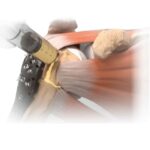 Matriz Ósea Desmineralizada Grafton Mexico | Soluciones para Traumatología y Ortopedia en México | IGEA