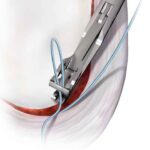 Sutura de Alta Resistencia ORTHOCORD mexico | Soluciones para Traumatología y Ortopedia en México | IGEA