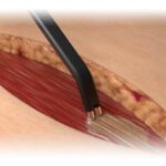 Aquamantys Bipolar 6.0 | Soluciones para Otorrinolaringología en México | IGEA